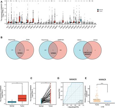 Long-Noncoding RNA MANCR is Associated With Head and Neck Squamous Cell Carcinoma Malignant Development and Immune Infiltration